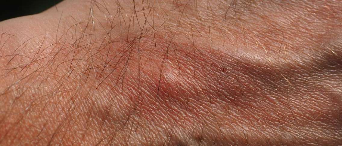 Ini Perbedaan Alergi dan Intoleransi Makanan