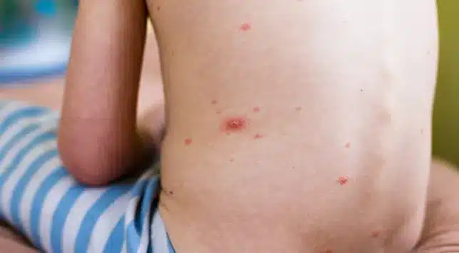 Hasil Observasi Terbaru, Pasien Asal Singkawang Bukan Terkena Cacar Monyet, Tapi..