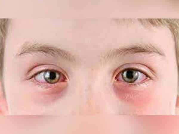 Apakah Sakit Mata Menular Lewat Pandangan? Ini Penjelasannya