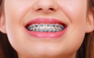 Masih Bingung Mau Pasang Behel Gigi? Simak 3 Fakta Berikut Ini