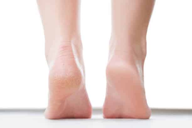 Tips dan Trik Efektif Menghilangkan Kapalan di Kaki