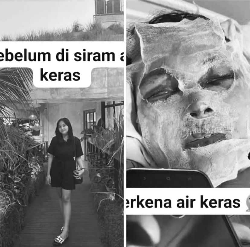 Viral, Mahasiswi asal Ketapang Disiram Air Keras oleh Orang Tak Dikenal Saat Malam Natal di Jogja