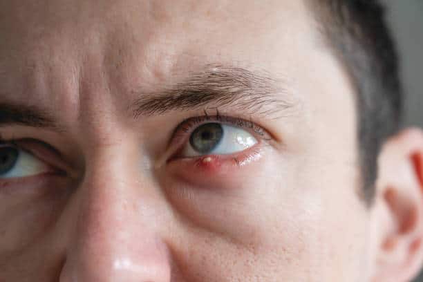 Tips Menghilangkan Mata Bintitan dengan Cepat dan Efektif